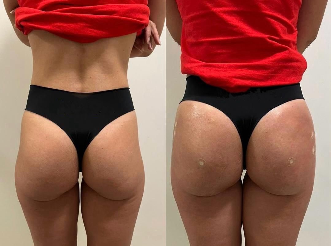 Harmonização glútea 🍑