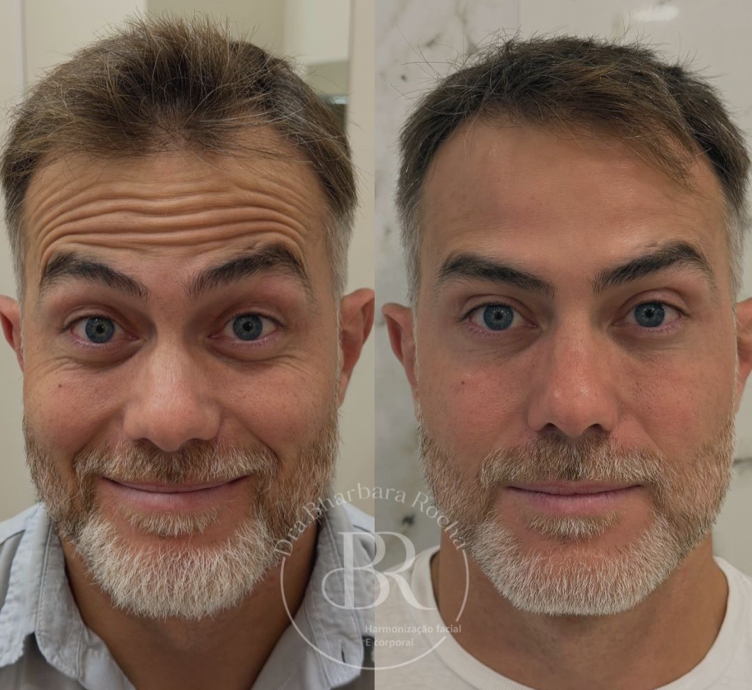 Prevenir é mais fácil que corrigir.O Botox é o melhor aliado para quem deseja envelhecer com lev