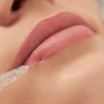 Procedure lip augmentation for young beautiful woman.